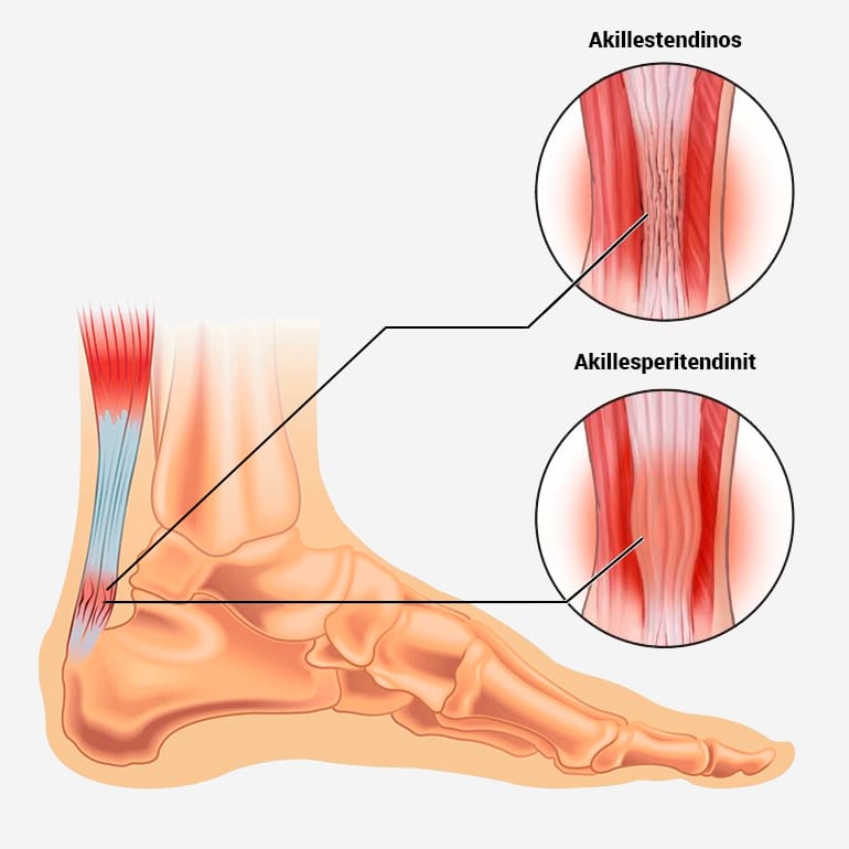 Hälseneinflammation, ont i hälsenan