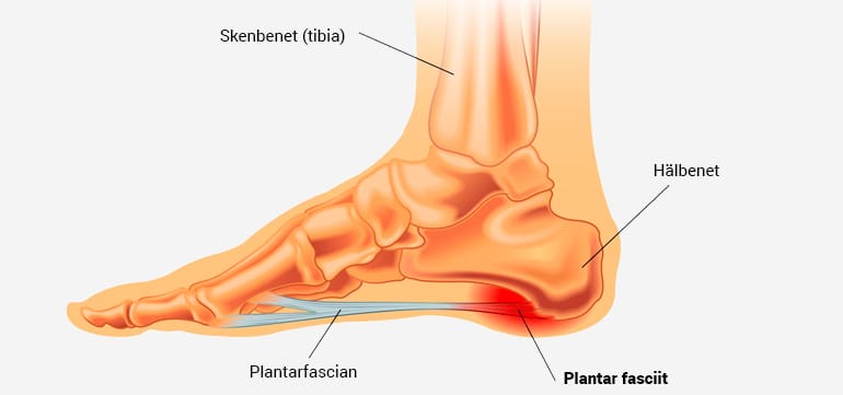 Plantar fasciit