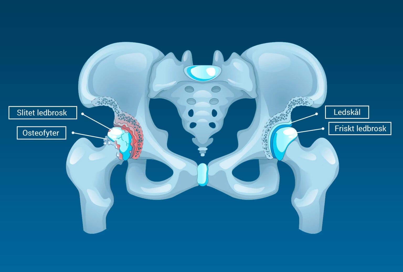 Artros i höftleden | Gå & Löpkliniken